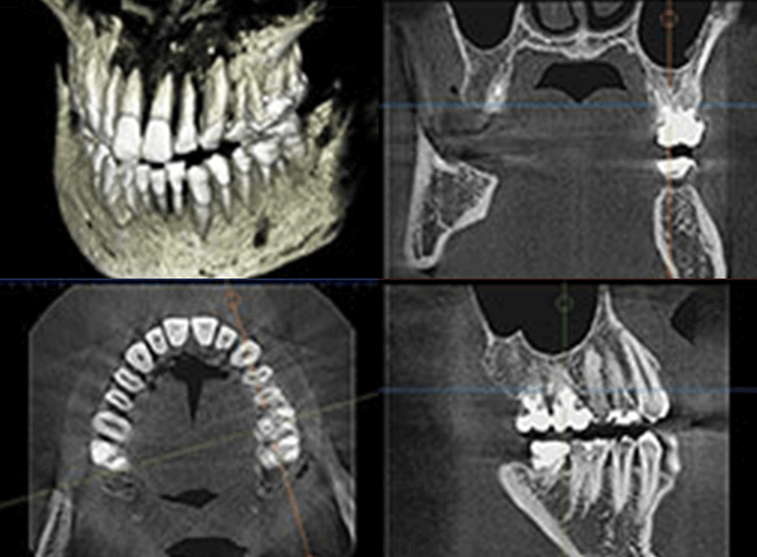 三次元の撮影で正確な診断を安全な治療を行うための歯科用CT