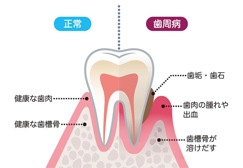 当院の歯周病治療における考え方