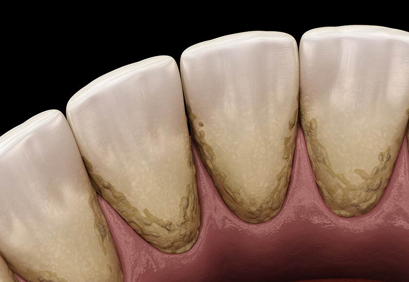 ブラッシングや歯石除去による「炎症のコントロール」